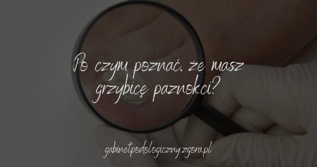 Po czym poznać, że masz grzybicę paznokci?