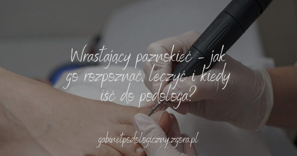 Wrastający paznokieć – jak go rozpoznać, leczyć i kiedy iść do podologa?